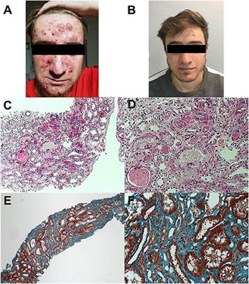 Kidney Involvement in PSTPIP1 Associated Inflammatory Diseases (PAID): A Case Report and Review of the Literature